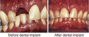 Before After Implant