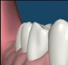 Gum Disease Treatment 