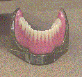 Implant Overdenture or an Implant Retained Denture