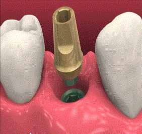 Restoring Dental Implants